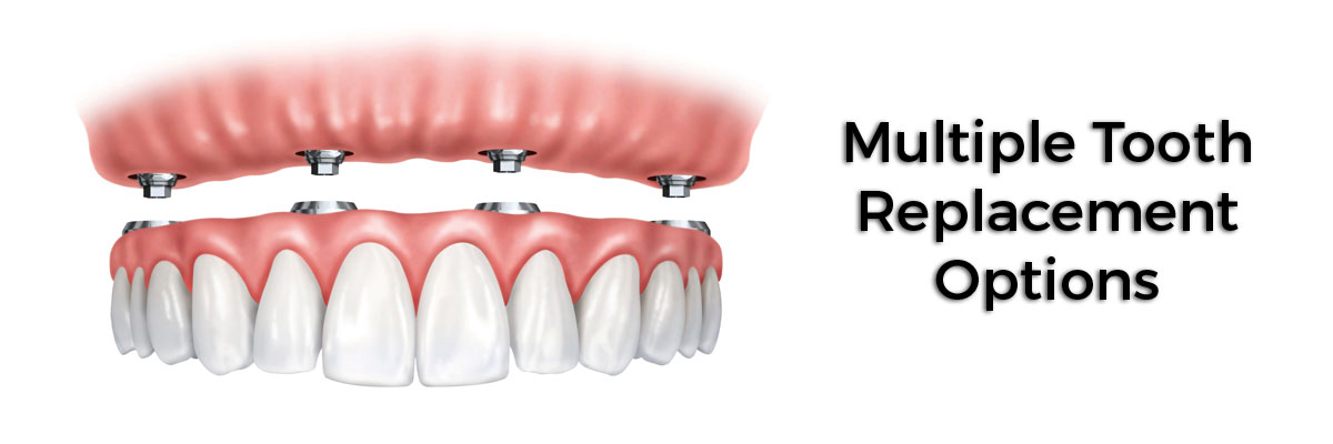Wantagh Multiple Teeth Replacement Options