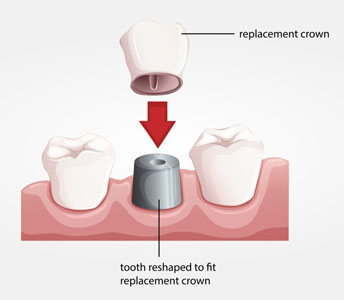 Dental Crowns And Bridges At Your Dentist