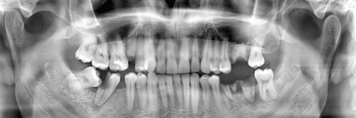 Wantagh Wisdom Teeth Extraction